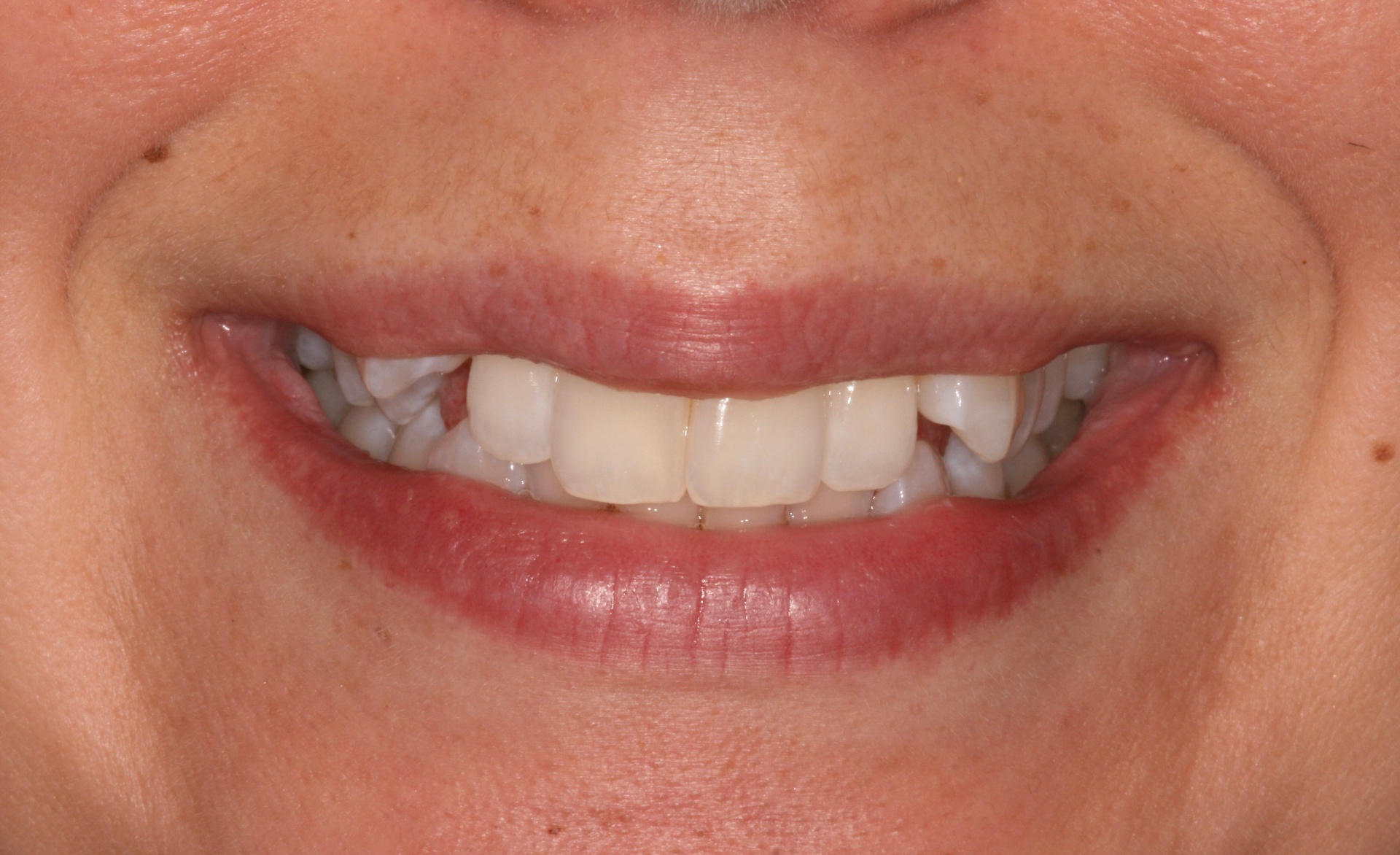 Aesthetic tooth alignment with Invisalign treatment (14 months treatment time). — before treatment at NewSmile Dental Centre