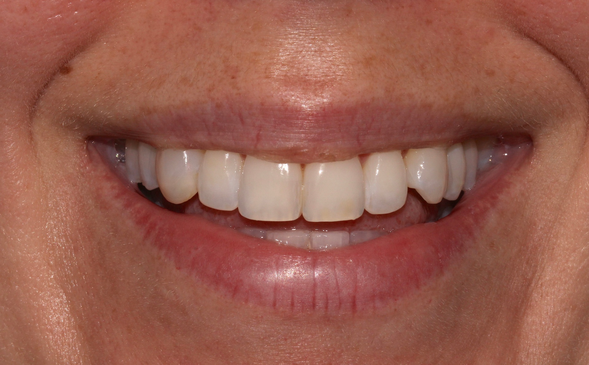 Aesthetic tooth alignment with Invisalign treatment (14 months treatment time). — after treatment at NewSmile Dental Centre