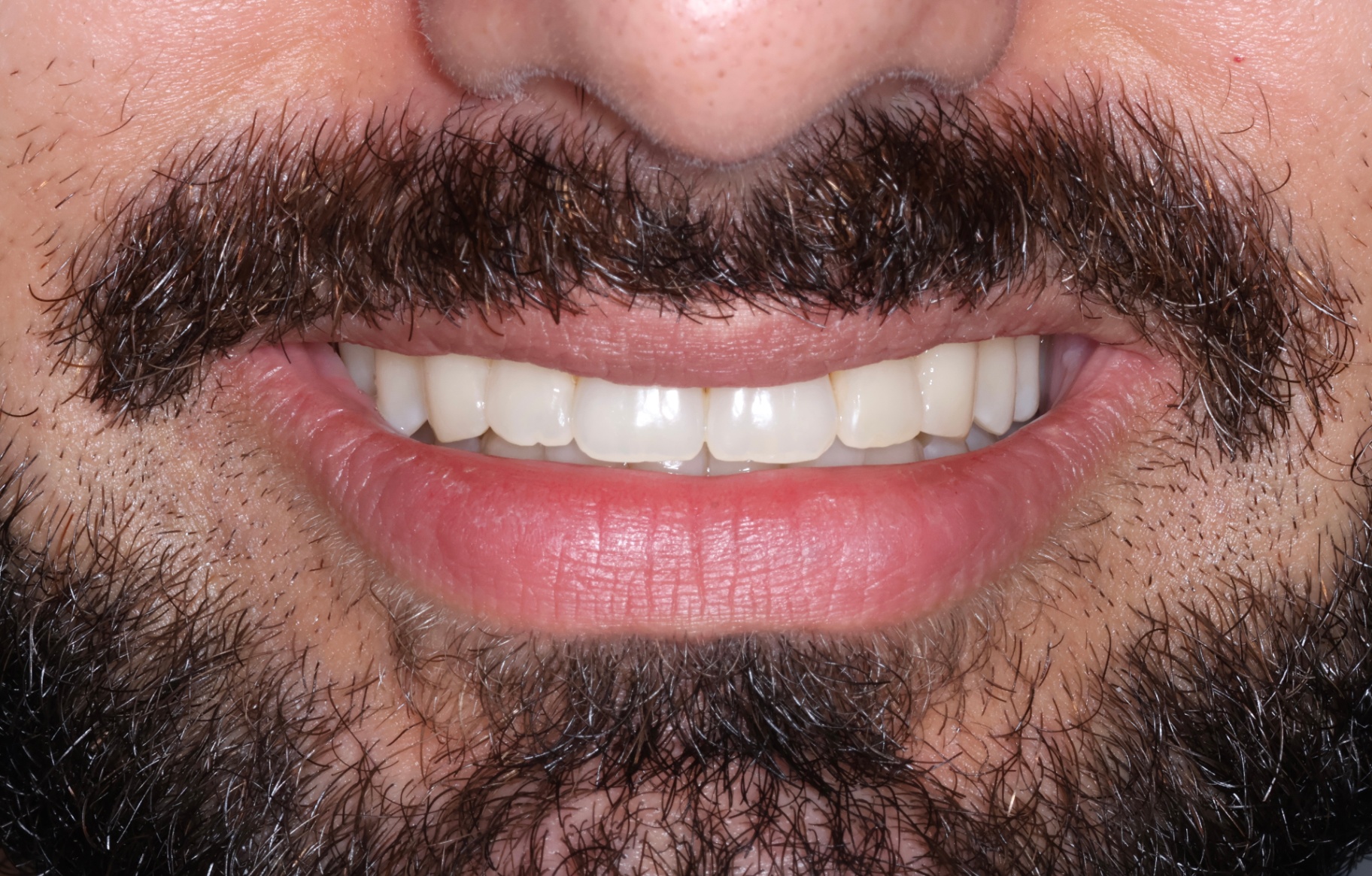 Invisalign treatment to align the teeth, broaden the smile, improve occlusion and create smile harmony (18 months treatment time). — after treatment at NewSmile Dental Centre