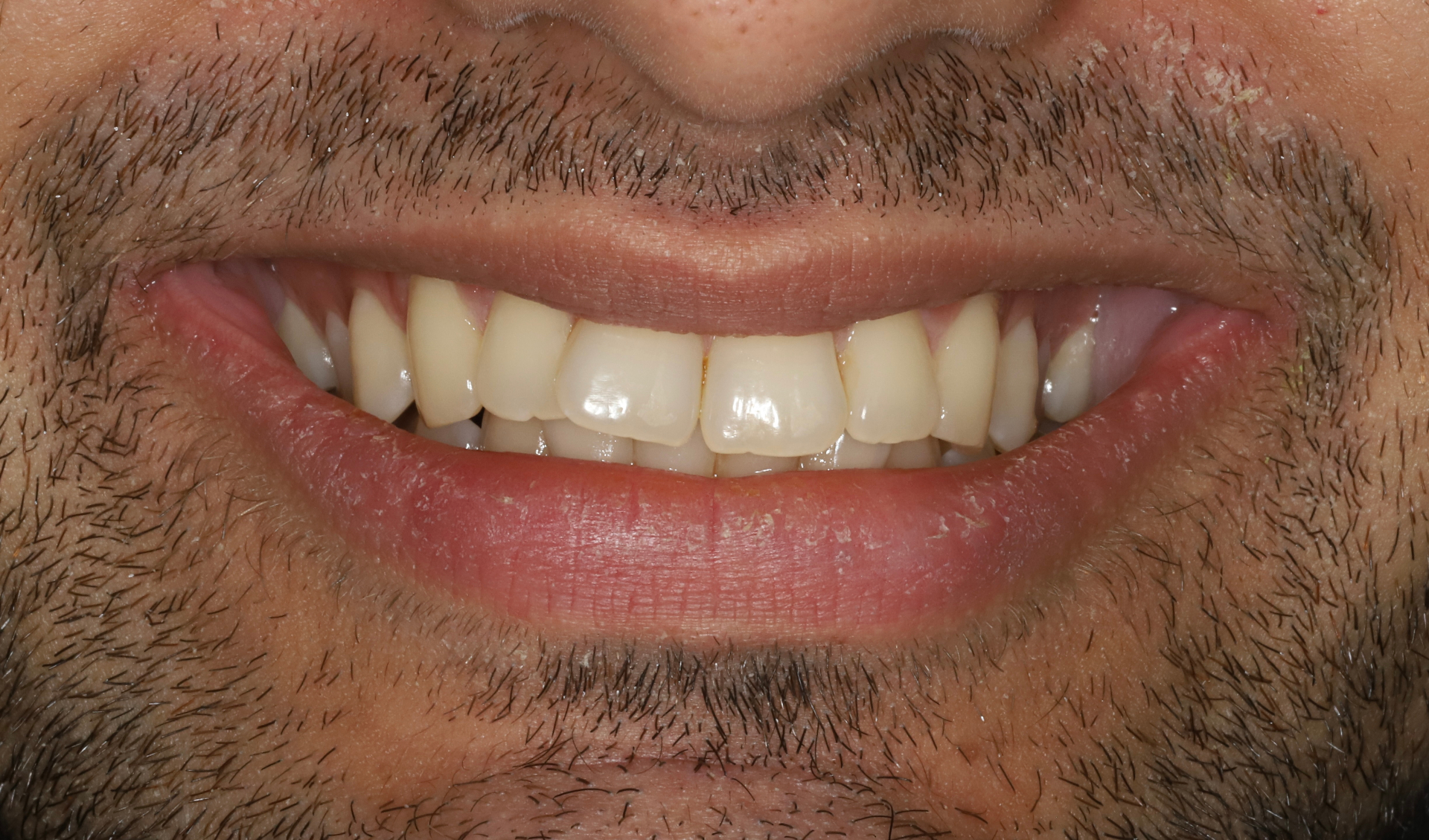 Invisalign treatment to align the teeth, broaden the smile, improve occlusion and create smile harmony (18 months treatment time). — before treatment at NewSmile Dental Centre