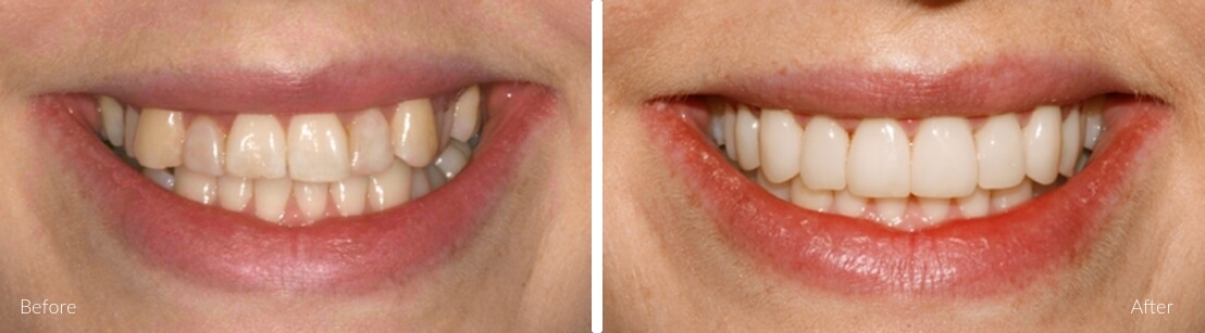 Emma S. — Crowding & Alignment before and after Invisalign at NewSmile Dental Centre