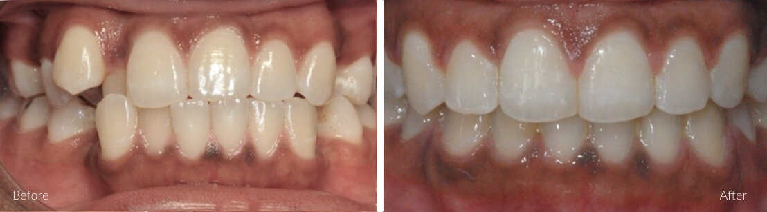 Daniel R. — Crossbite Correction before and after Invisalign at NewSmile Dental Centre